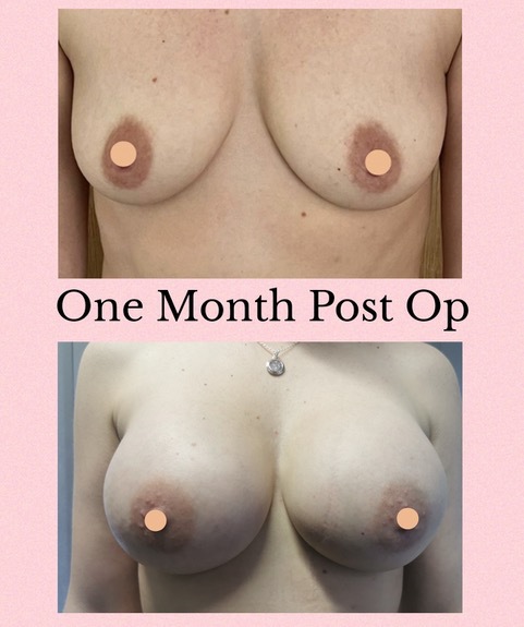 Photo 2 for addition to breast augmentation gallery and to page on breast augmentation